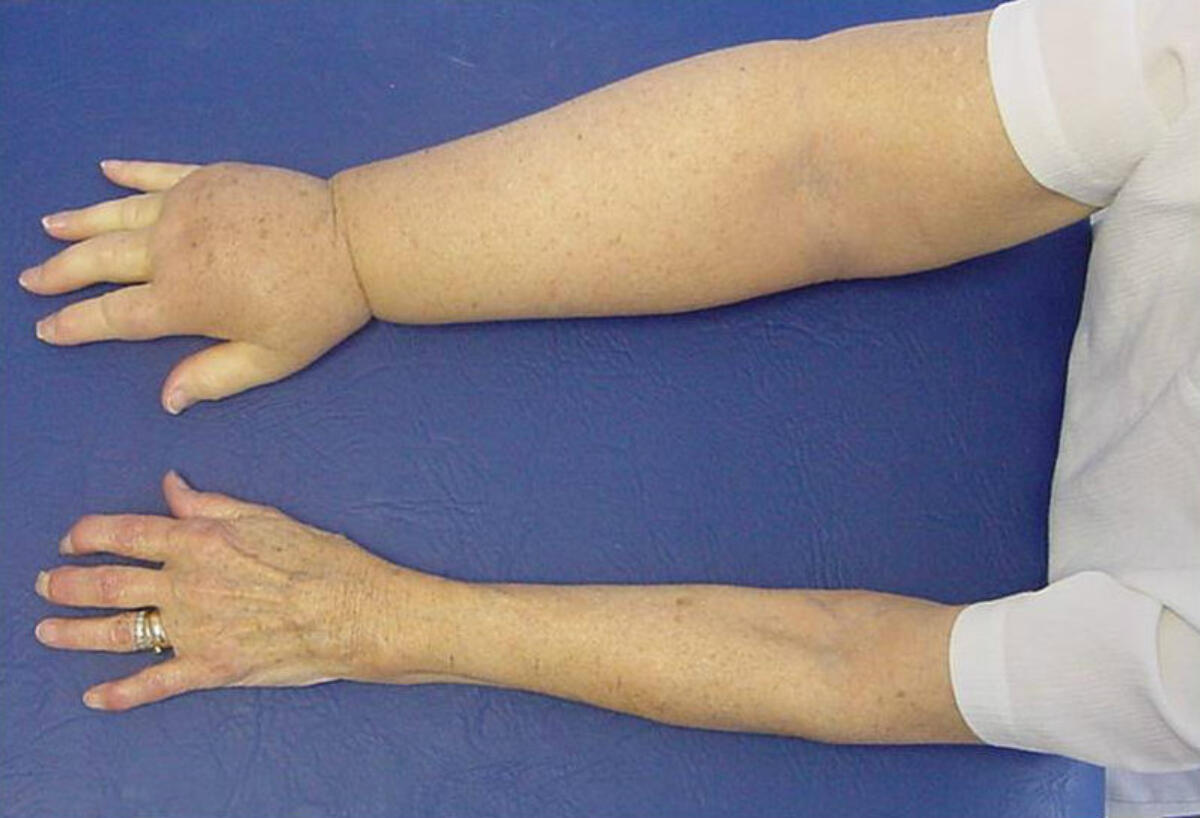 Lymphinarms